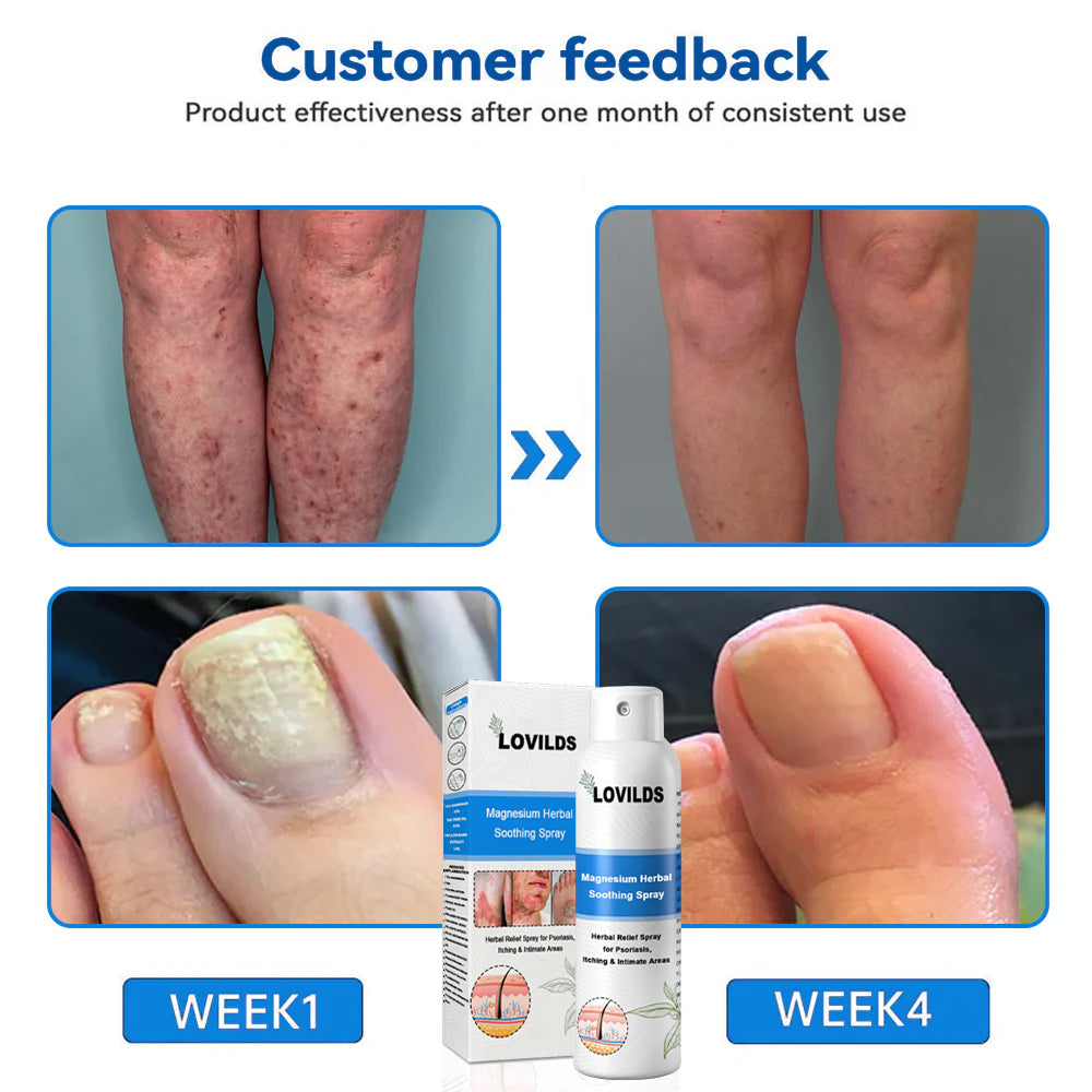 ✅ Official Store: LOVILDS® Magnesium Herbal Psoriasis Spray 👨⚕️ FDA Certified (Relieves Psoriasis and Eczema, Improves Bacterial Infections in the Genital Area, Treats Acne and Warts)