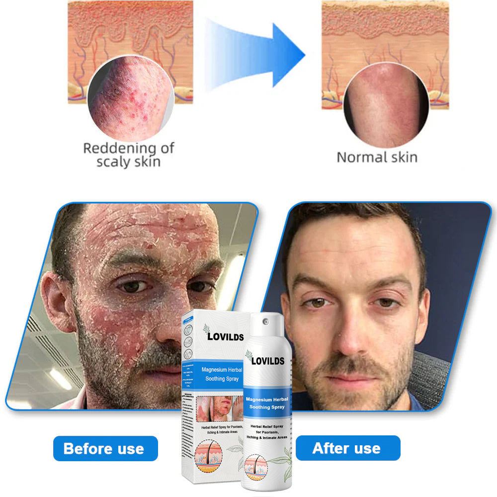✅ Official Store: LOVILDS® Magnesium Herbal Psoriasis Spray 👨⚕️ FDA Certified (Relieves Psoriasis and Eczema, Improves Bacterial Infections in the Genital Area, Treats Acne and Warts)