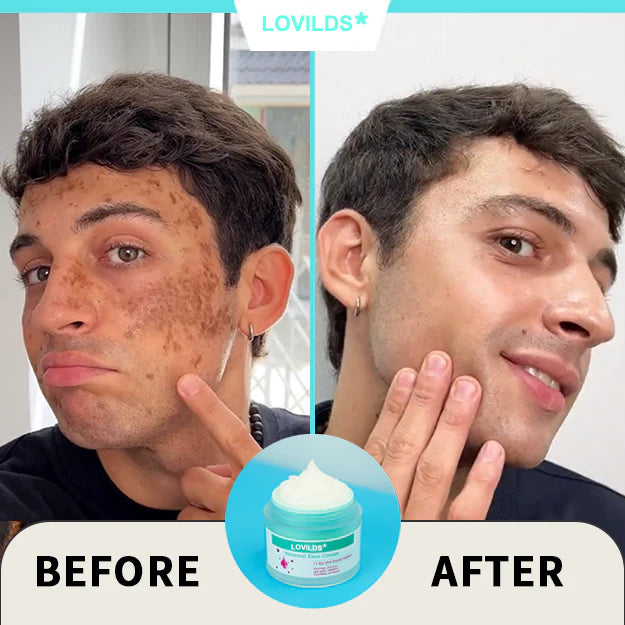 Final Hours—Sale Ending Soon!💥LOVILDS* Renewal Skin Cream | Spot Removal & Skin Renewal for Dark Spots, Age Spots, and Sun Spots* Daily Firming for All Skin Types
