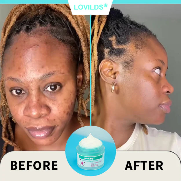 Final Hours—Sale Ending Soon!💥LOVILDS* Renewal Skin Cream | Spot Removal & Skin Renewal for Dark Spots, Age Spots, and Sun Spots* Daily Firming for All Skin Types
