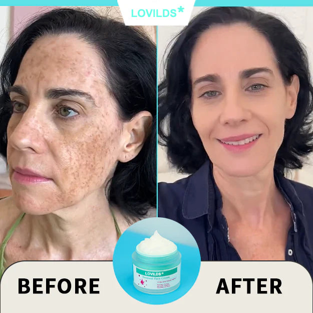 Final Hours—Sale Ending Soon!💥LOVILDS* Renewal Skin Cream | Spot Removal & Skin Renewal for Dark Spots, Age Spots, and Sun Spots* Daily Firming for All Skin Types